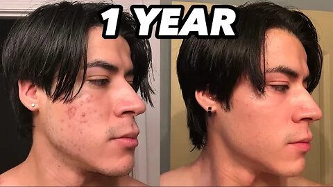 The UGLY Up & Down Journey Of Healing My ACNE (1 Year SKIN Time Lapse)