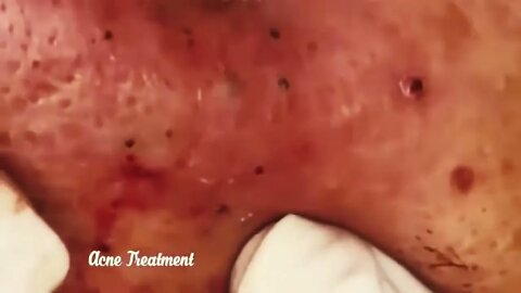 Satisfying Video Blackhead Removal For Relaxation | 2022 Video