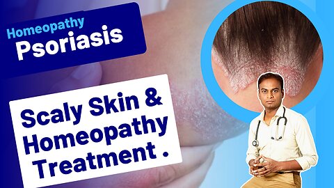 Psoriasis and Homeopathy Treatment . |Dr. Bharadwaz | Medicine & Surgery Homeopathy