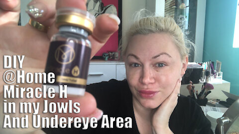 Liquid PCL (MIracle H) in my Jowls and Undereye | Code Jessica10 Saves you Money!