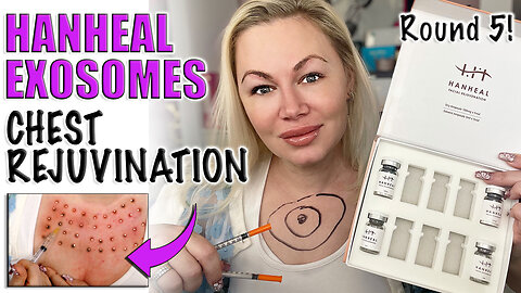 Chest Rejuvenation with Hanheal Exosomes, AceCosm| Code Jessica10 saves you money!