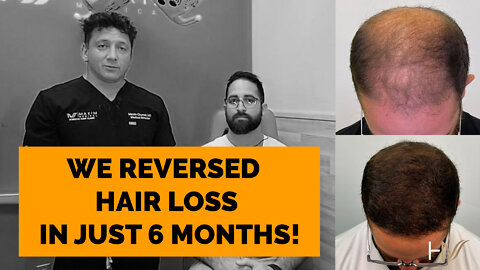 We Reversed Hair Loss In Just 6 Months!