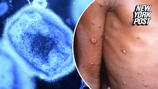 What you need to know about Monkeypox