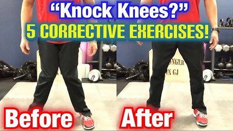 "Knock Knees" *Genu Valgum* 5 BEST CORRECTIVE EXERCISES! | Dr Wil & Dr K