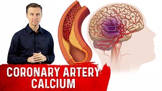 How to Read a Coronary Artery Calcium (CAC) Score