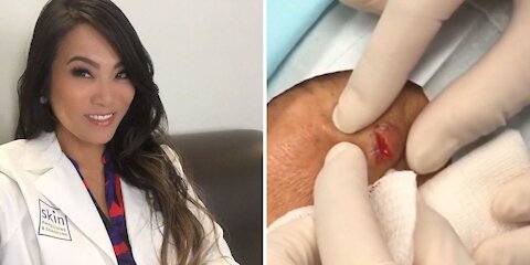 Insane pimple popping