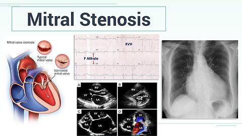 Mitral Stenosis - Pathophysiology, Clinical Features, Diagnosis & Management