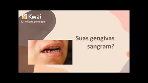 [pt. 1] Se suas gengivas sangram, pode ser sinal de deficiência dessa vitamina