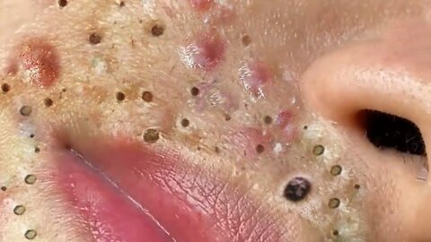 Blackheads, Blackhead Removal, Acne Extraction Relaxing #55.