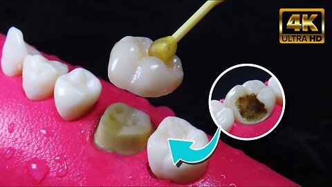 Amazing restoration of tooth damaged by caries | Restoring and Building