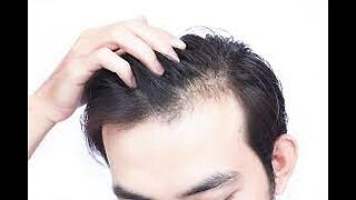 Natural Solution for Hair Loss