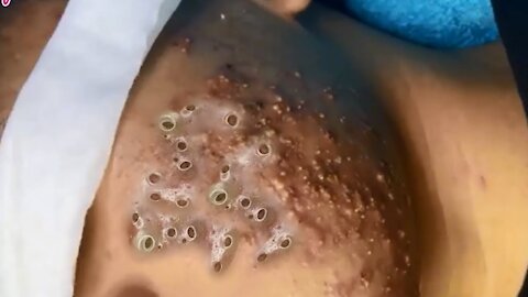 Acne, Blackheads Extraction, Giant Carnations, Satisfying, Blackheads & Milia, Whiteheads Removal