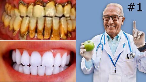 The #1 Teeth Whitening Remedy, Dental Plaque, Cavities, and Gingivitis