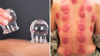 Cupping Therapy: An Ancient Technique With Many Health Benefits (Hijama Therapy)