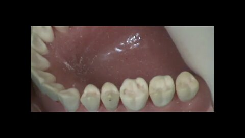 Class I Upper Right Second Premolar