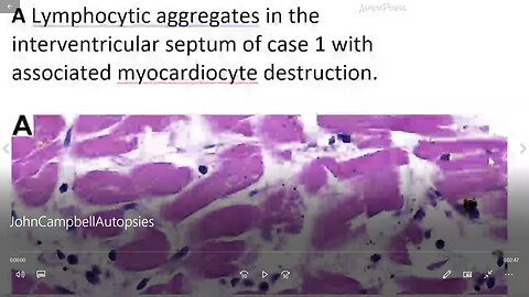 Autopsy-based myocarditis after anti-SARS-CoV-2-vaccination - Dr. John Campbell