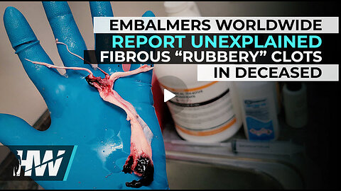 EMBALMERS WORLDWIDE REPORT UNEXPLAINED FIBROUS “RUBBERY” CLOTS IN DECEASED