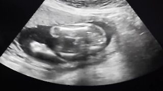 Fetal heartbeat bill filed in Florida