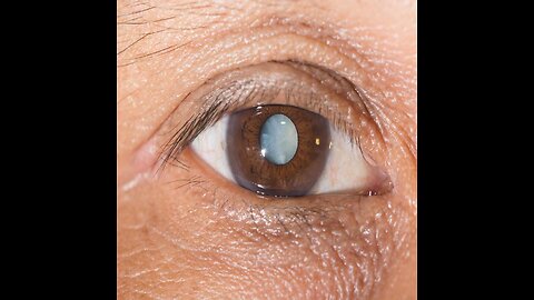 Mar. 28, 2024 AM / Cataracts and alternatives to surgery!