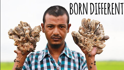 They Call Me 'The Tree Man' | BORN DIFFERENT