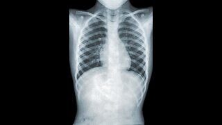 HERE WE GO: Mystery Pneumonia From China Hits US, Meets Definition Of "Outbreak" Ahead Of 2024