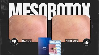 Get Rid of Smile Lines with MesoTox - Innotox & Ammi Capture Time Premium