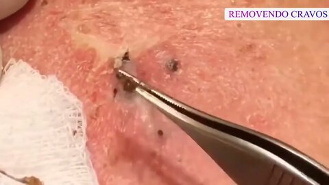 Satisfactory Video Blackhead Removal For Relaxation | 2022