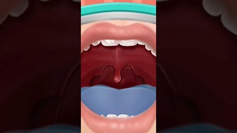 Removal of Tonsils Part #4 #shorts #games #doctor