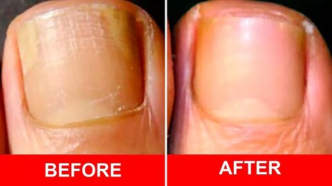 Cure Foot and Toenail Fungus Fast With These Simple Recipe