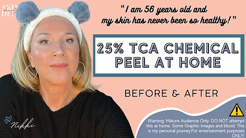 TCA Chemical Peel AT HOME ~ BEFORE & AFTER