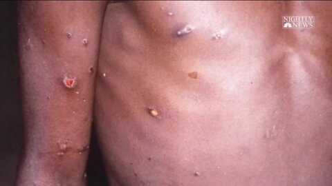 Monkeypox detected in Milwaukee resident, doctor explains the disease