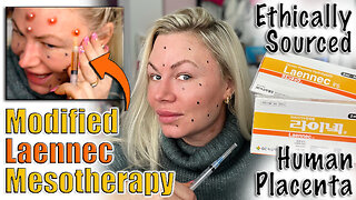 Modified Laennec Mesotherapy for a Glowing Face! AceCosm | Code Jessica10 saves you Money