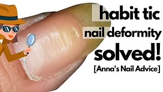 Uneven ridgy thumbnails | Habit Tic Nail Deformity SOLVED!