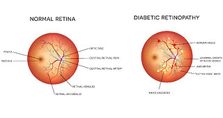 Can diabetes affect your eye health?