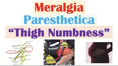 Meralgia Paresthetica (“Numbness of the Thigh”) | Causes, Symptoms, Diagnosis, Treatment