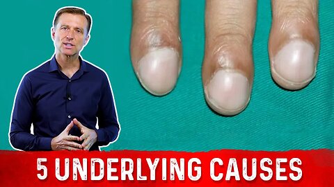 What Causes Clubbing of the Nail?