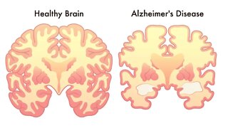 5 Habits That May Reduce Your Risk for Developing Alzheimer's