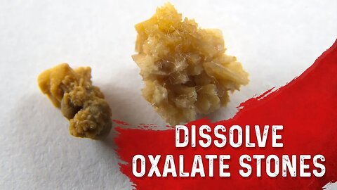 Why You Get Kidney Stones (Oxalate Type) – Removing Kidney Stones & High Oxalate Foods – Dr.Berg