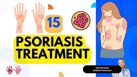 15 Psoriasis treatments