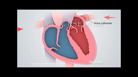Síndrome del corazón izquierdo hipoplásico YT