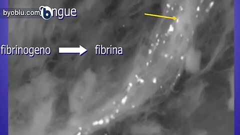 Nanoparticelle come causa di trombi, embolia polmonare e ischemia - Stefano Montanari