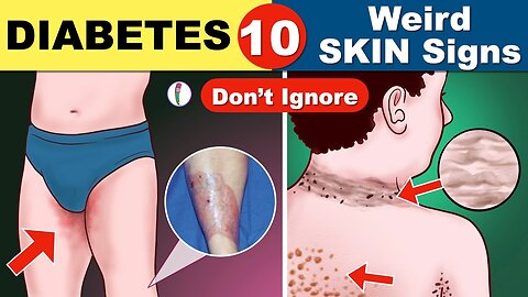 Diabetes skin signs | Diabetes symptoms | Signs of Diabetes | Diabetes mellitus | Type 1 diabetes