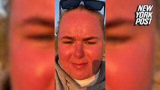 Woman's face 'doubles in size' after spending an hour in the sun