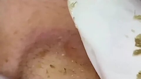 Extreme blackheads squeezing on nose 👃🪱 #blackheadremoval #blackheads #blackhead #blackheadsremoval