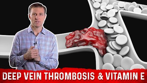 Deep Vein Thrombosis (Blood Clots in Legs) & Vitamin E – Dr. Berg
