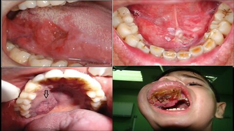 Oral Surgery L12 (Oral Cancer)