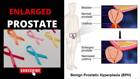 An Enlarged Prostate: What It Is and How to Treat It