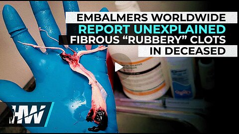 Embalmers Worldwide Report Unexplained Fibrous Clots In Deceased