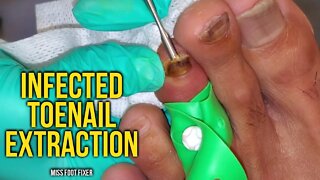 Infected Toenail EXTRACTION *** Toe Injured BEST Treatment! by miss foot fixer