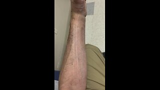 Broken wrist from skateboarding - #skateboardingisfun